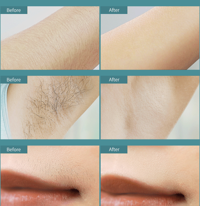 מכשיר ביתי להסרת שיער בלייזר